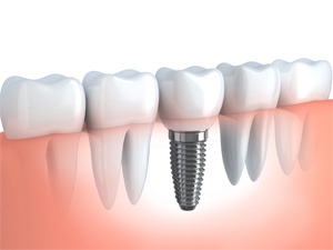 What is a dental implant?